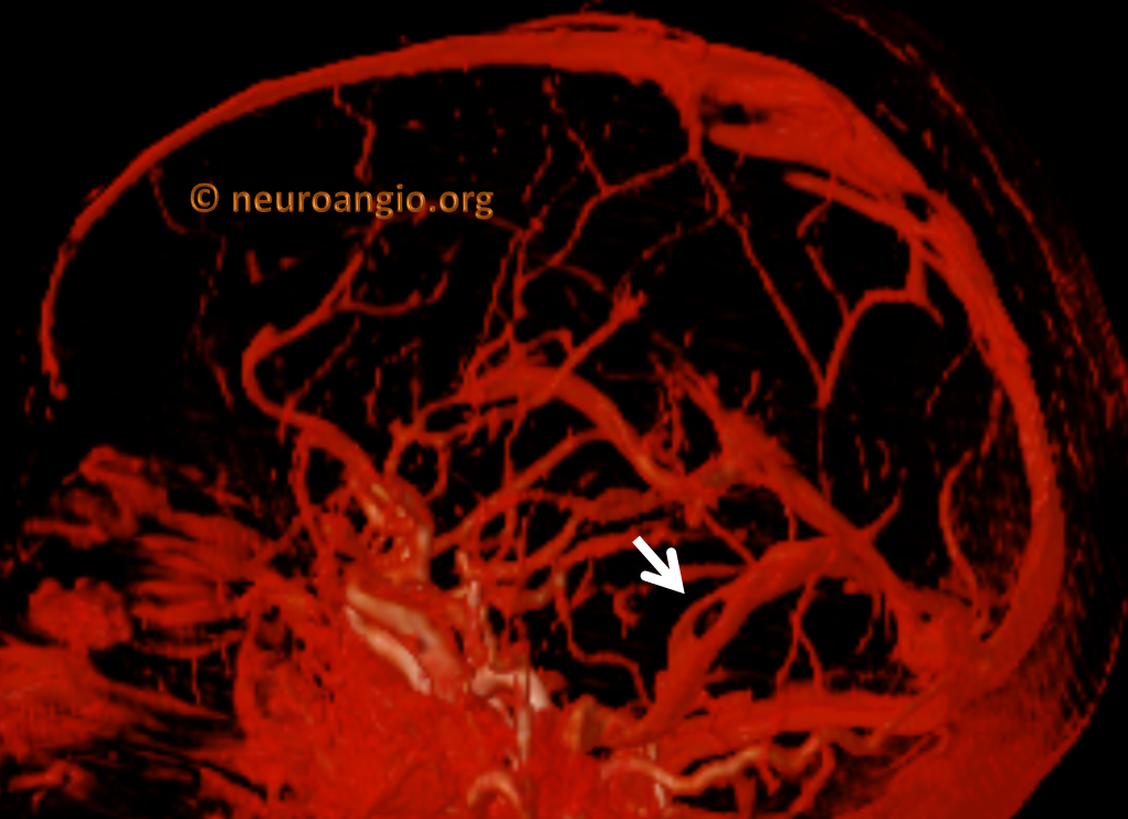 pulsatile-tinnitus-venous-sinus-stenosis-neuroangio